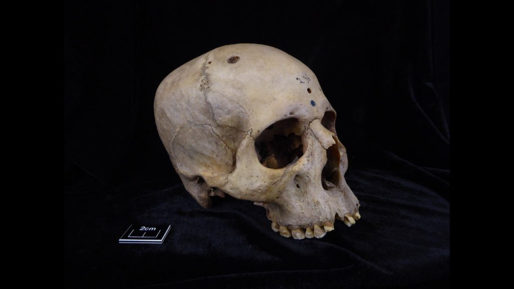 Egyptische schedel 236, hierin zijn sporen van tumoren en kankerbehandeling aangetroffen