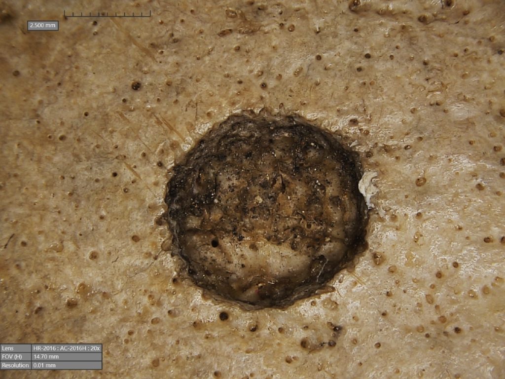 Egyptische schedel 236 met een grote laesie waar een hersentumor moet hebben gezeten. Zichtbaar zijn ook snijsporen van een scherp instrument.