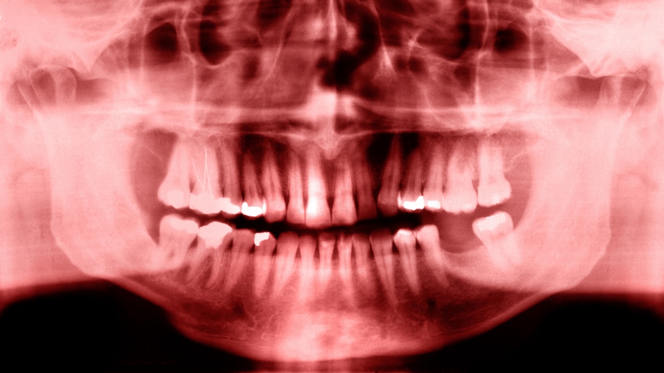 Röntgenfoto van gebit met tanden