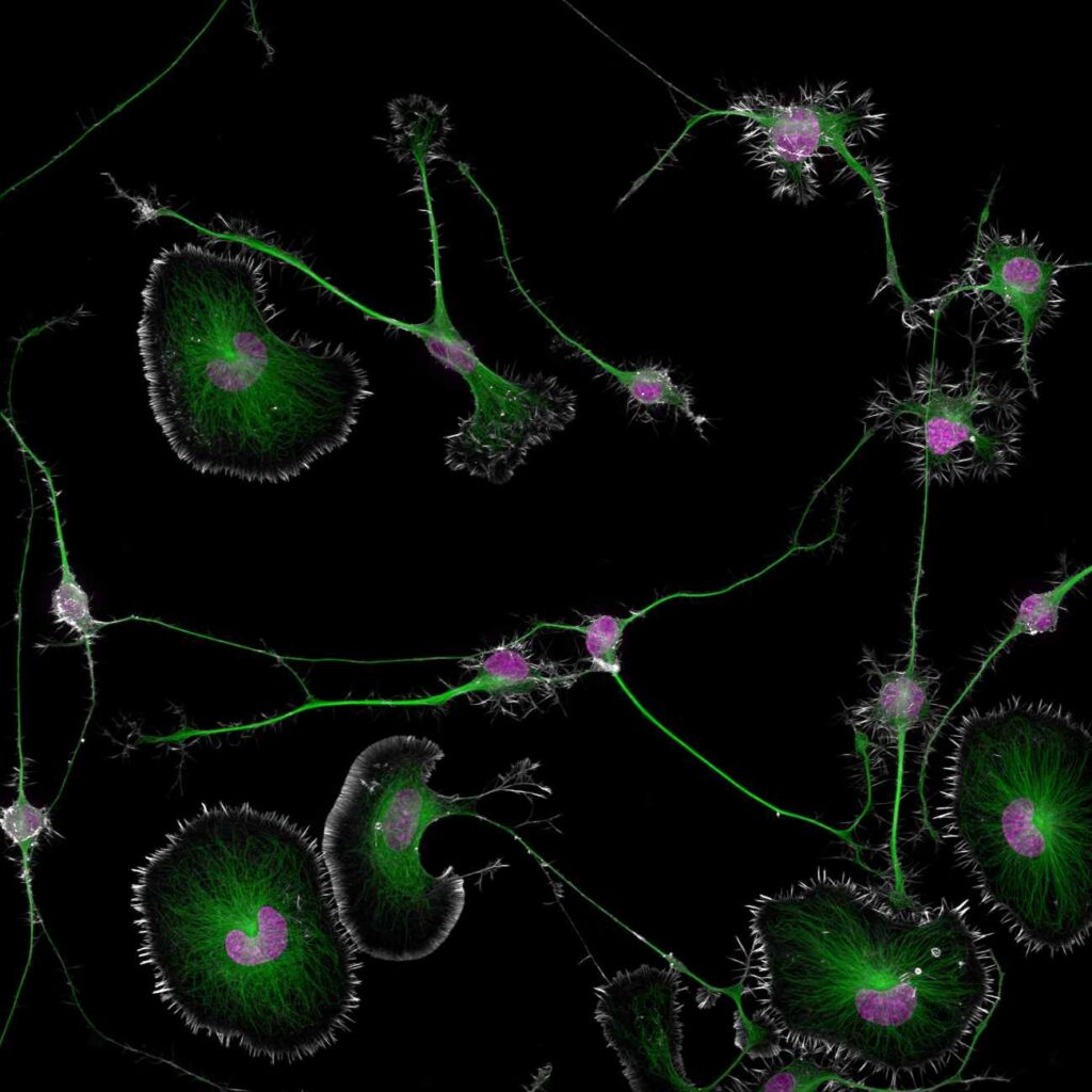 'Normale' tumorcellen en misvormde tumorcellen, celkernen zijn paars en het cytoskelet en microtubuli groen. 